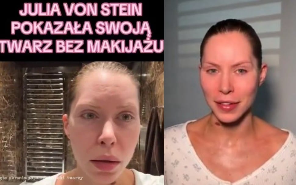 Julia von Stein ostrzega przed operacjami plastycznymi. Twierdzi, że teraz nie może się uśmiechać i musi przejść kolejną operację Zdjęcie główne wpisu