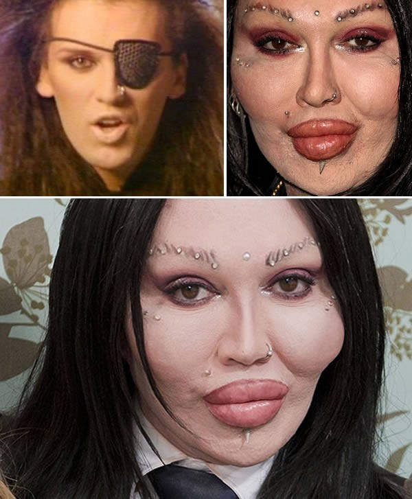 7 W 2007 roku gwiazda muzyki pop Pete Burns pozwał swojego chirurga plastycznego za “zrujnowanie kariery i życia”.