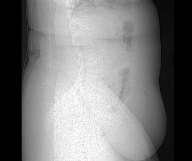 9. Prześwietlenie osoby cierpiącej na otyłość. Nadmierna tkanka tłuszczowa utrudnia zobaczenie znajdujących się pod nią kości