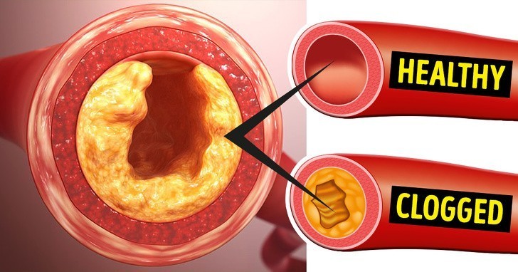 Bonus: Jak poznać, że twoje arterie są zatkane?
