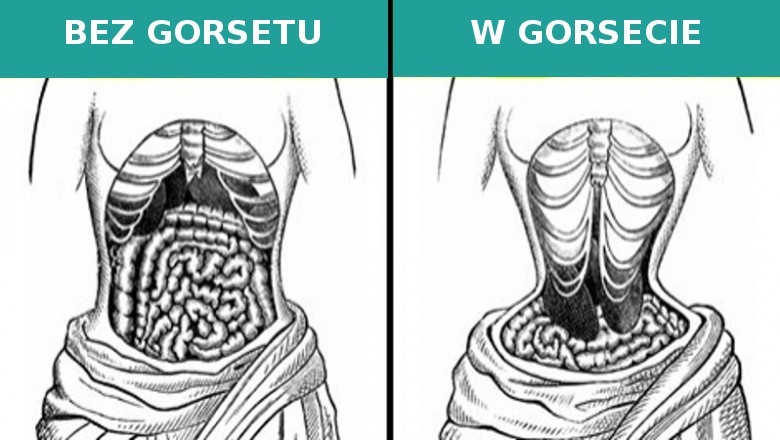 5. Gorsety tak ciasne, że zmieniały anatomię