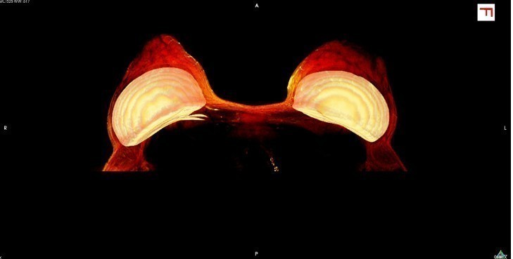 5. Implanty piersi widoczne na rezonansie magnetycznym