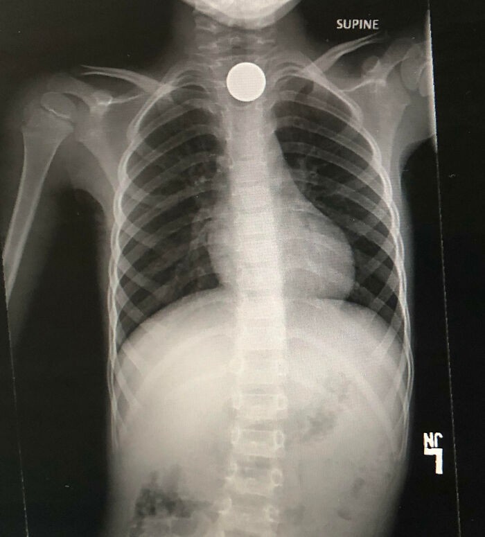 Syn połknął monetę 5-centową, zamieniając 0,05 dolara w rachunek medyczny na 4400 dolarów.