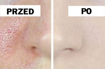 Masz problem z otwartymi porami na swojej cerze? Ta 3 dniowa terapia pozwoli Ci się ich pozbyć!