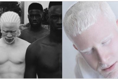 17 zdjęć ludzi cierpiących na albinizm! Wyglądają jak duchy, aż ciężko uwierzyć, że to nie przeróbki!