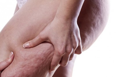 6 ważnych faktów na temat celolitu które pomogą Ci ułatwić walkę z niechcianym problemem! 