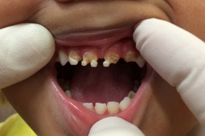 Dentysta jest w szoku gdy zagląda w usta 3-letniego chłopca! Od razu pyta mamę czy mały pije...?