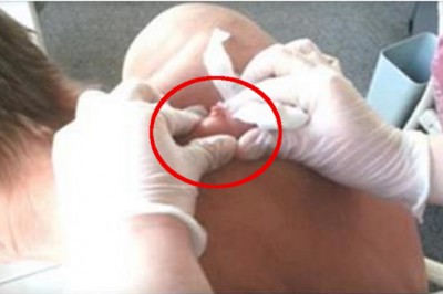 Gdy zaczął wyciskać tego pryszcza zrobiło mi się niedobrze! Będzie ciężko obejrzeć do końca!