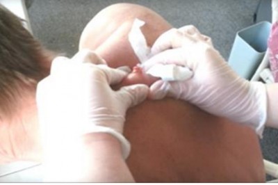 Gdy zaczął wyciskać tego pryszcza zrobiło mi się niedobrze! Nie dasz rady obejrzeć do końca! 