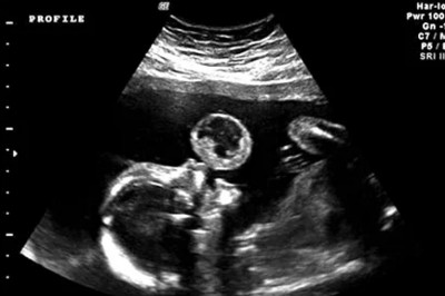 Kobieta myślała, że na USG widać jak dziecko puszcza bańki! Wtedy lekarz przekazuję jej złe nowiny!