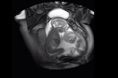Kobieta w ciąży miała badanie rezonansem. To co ujrzała na ekranie po prostu zapiera dech!