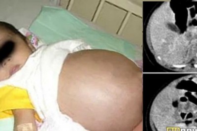 Lekarze sądzili, że w jej brzuchu rozwija się guz! To co zobaczyli w środku zupełnie ich zaskoczyło!