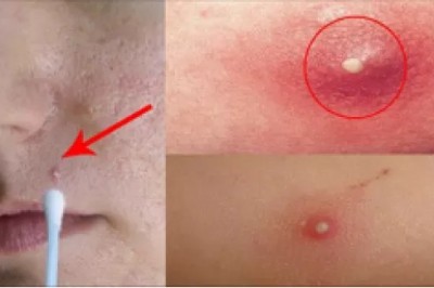 Najlepszy sposób by pozbyć się uciążliwych pryszczy! Masz wszystkie składniki w domu! 