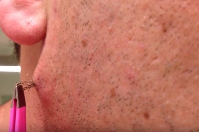 Obrzydliwe! Najdłuższy wrośnięty włos jaki widziałam! Ile on to wyciągał! 