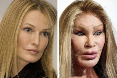 Operacje plastyczne które poszły naprawdę źle. Zobacz efekty.