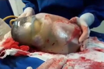 Pielęgniarka uchwyciła niesamowity poród! Dziecko rodzi się w nienaruszonym worku owodniowym