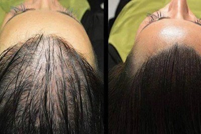 Rezultaty Cię zaskoczą! Poznaj naturalny sposób który sprawi, że Twoje włosy będą bardziej gęste! 