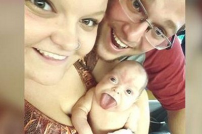 Urodziła się z językiem jak dorosły! Dzięki interwencji chirurgów mogła się w końcu uśmiechnąć do rodziców!