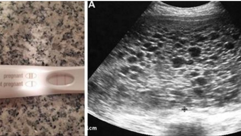 Widząc pozytywny test ciążowy bardzo się cieszy! Podczas USG lekarz zamiast dziecka dostrzega setki...
