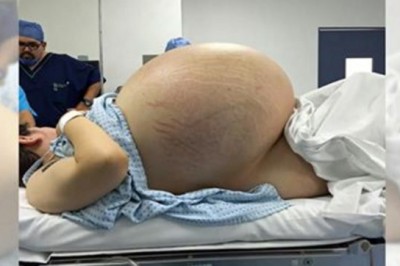 Wyglądała jak w ciąży z 5 raczkami! Gdy lekarze prześwietlili jej brzuch nie mogli uwierzyć co znaleźli!