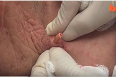 Zgłosiła się do lekarza ze zwykłym pryszczem! Okazało się, że problem był o wiele większy!