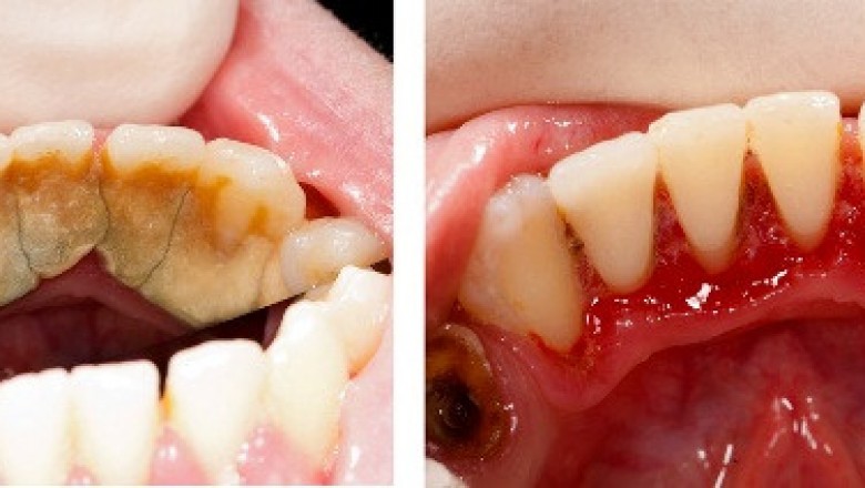 Zostań własną dentystką! Domowy sposób na usunięcie płytki nazębnej! Odzyskaj biały uśmiech!