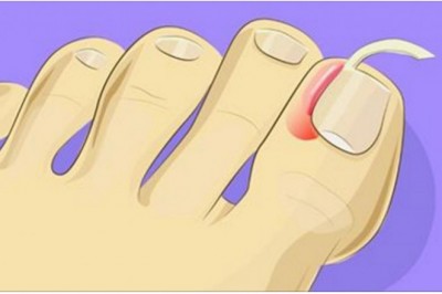 Zobacz jak w łatwy sposób poradzić sobie z wrastającymi paznokciami! Nie potrzeba pomocy lekarza!