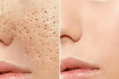 Poznaj 4 domowe sposoby, żeby pozbyć się otwartych porów na twarzy! Uzyskaj gładką cerę! 