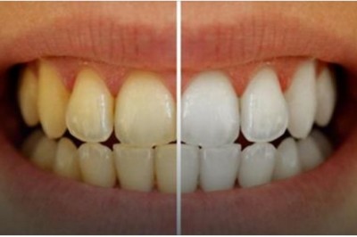 Wymieszał te dwa składniki i umył tym zęby! Efekt jest rewelacyjny i koniecznie muszę spróbować!