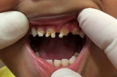 Dentysta jest w szoku gdy zagląda w usta 3-letniego chłopca! Od razu pyta co dziecko dostaje do picia!