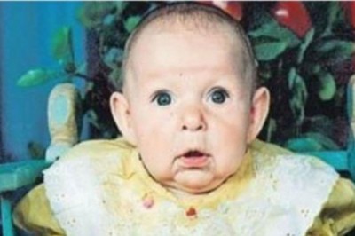 Ojciec wyrzekł się córki widząc jej twarz gdy dorasta! Po 20 latach udowodniła gdzie tkwi piękno!