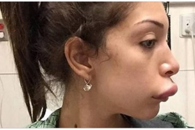 Te zabiegi powiększanie ust poszły zupełnie niezgodnie z planem! Zobacz  jak pogorszyć swój wygląd! 