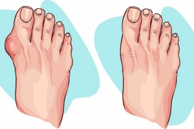 Te 5 produktów pomoże Ci zmniejszyć haluksy! Dodatkowo zmniejszają uporczywy ból stopy!