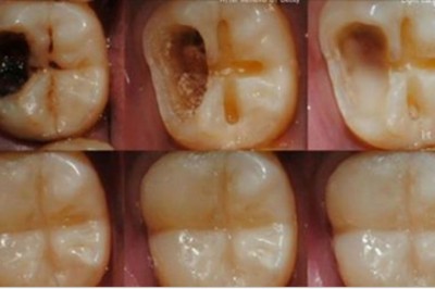 5 łatwych kroków, które pozwolą Ci uzdrowić Twoje zęby i zapomnieć o ubytkach! To łatwiejsze niż myślisz!
