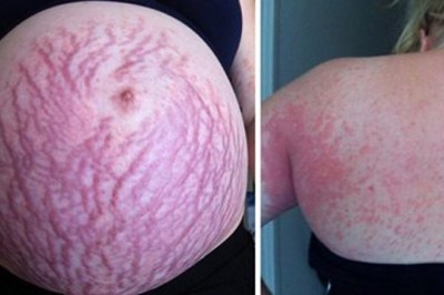 Ciało przyszłej mamy zaczęła pokrywać dziwna wysypka! Najgorzej wyglądał jej brzuch! 