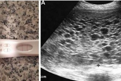 Sprawdzając test ciążowy bardzo się cieszy! Podczas USG lekarz zamiast dziecka dostrzega setki