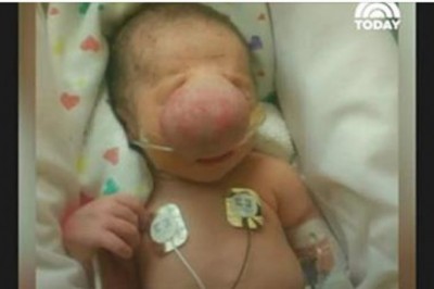 Lekarze usunęli wielką narośl z twarzy maluszka! To co było pod spodem sprawiło, że mieli łzy w oczach 