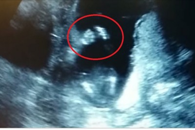 Przyszła mama poszła na badanie USG brzuszka! Lekarz na monitorze widzi nietypowe zachowanie dziecka! 