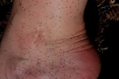 Wystarczył moment nieuwagi i oblazły ją tysiące kleszczy! Opowiedziała, co stało się potem! 