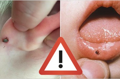 W tych miejscach ciała najczęściej zagnieżdżają się kleszcze! Zobacz gdzie się sprawdzić po spacerze! 