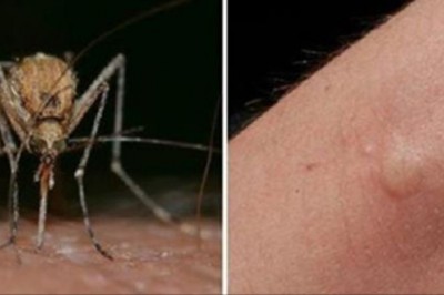 Byłam zawsze pogryziona przz komary ! Od czasu jak dodałam do diety te składniki zaczęły mnie omijać! 