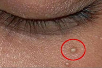 Masz problem z takimi białymi grudkami na swojej skórze?! Zobacz jak sobie z nimi poradzić!