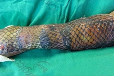 Jej ręce i nogi były pokryte rybią łuską przez 3 tygodnie! Kiedy lekarze ją ściągają są zaskoczeni rezultatem!