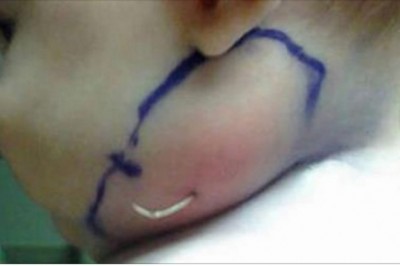 Z opuchniętego policzka dziecka lekarz wyciąga coś zaskakującego! Nie mógł zrozumieć jak to się stało!