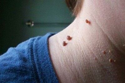 Prawie każdy je ma, lecz nie każdy wie, jak się ich pozbyć! Ta metoda czyni cuda!