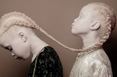 Bliźniaczki cierpiące na albinizm pozują do niezwykłej sesji! Lecz to wygląd 3 siostry budzi emocje!