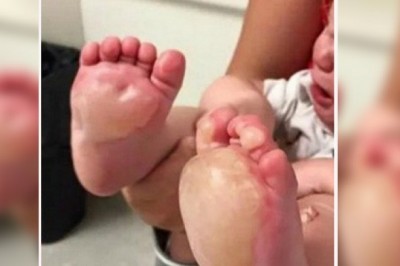 Mama widzi pęcherze na stopach córeczki! Kiedy zrozumiała co zrobiła opiekunka wpadła w furię!