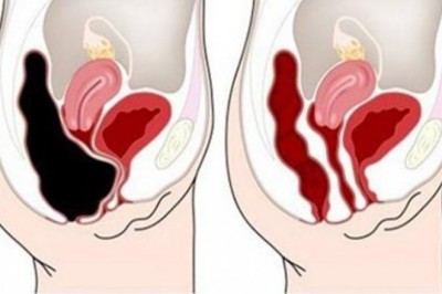 Stosują te dwa naturalne preparaty usunęła 9 kg nieczystości zalegających w organizmie! Zobacz jaka zmiana! 