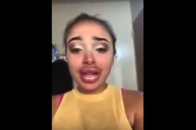 Tak się może skończyć poprawianie ust u kosmetyczek bez doświadczenia. Miała być oszczędność, a jest dramat