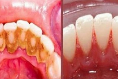 Babcia powtarzała, że ten prosty trik pozwala uniknąć dentysty. Nie wierzyłam, dopóki nie spróbowałam sama
